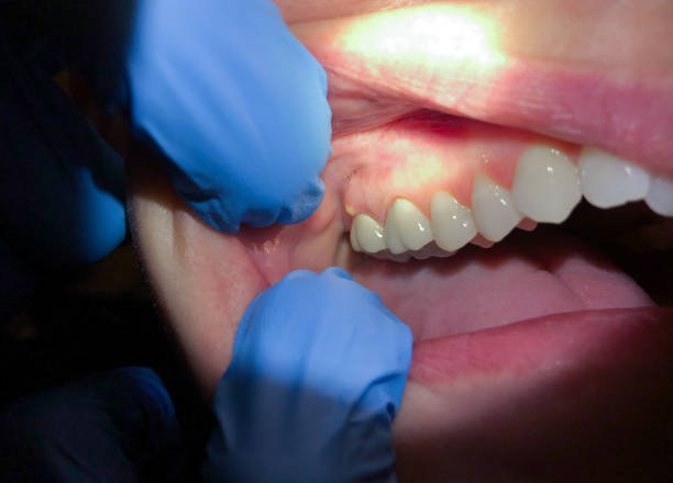 Best Cracked Tooth Emergency Dentist  in Lake Lorraine, FL